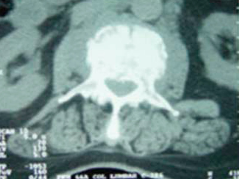 Caso clínico de fractura patológica de vértebra lumbar, tratada con analgesia neuroaxial epidural continua y ozono. Reporte de un caso