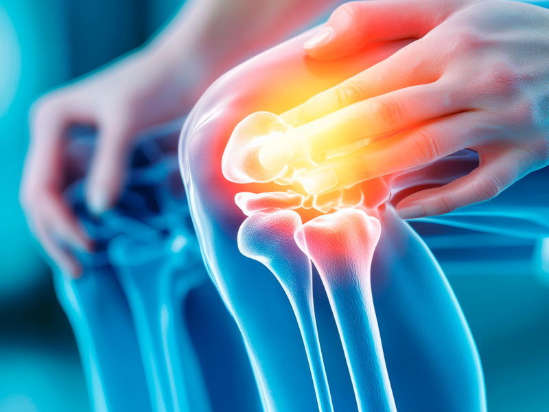 Treatment of gonarthrosis secondary to gonarthrosis with intra-articular ozone. Case presentation.